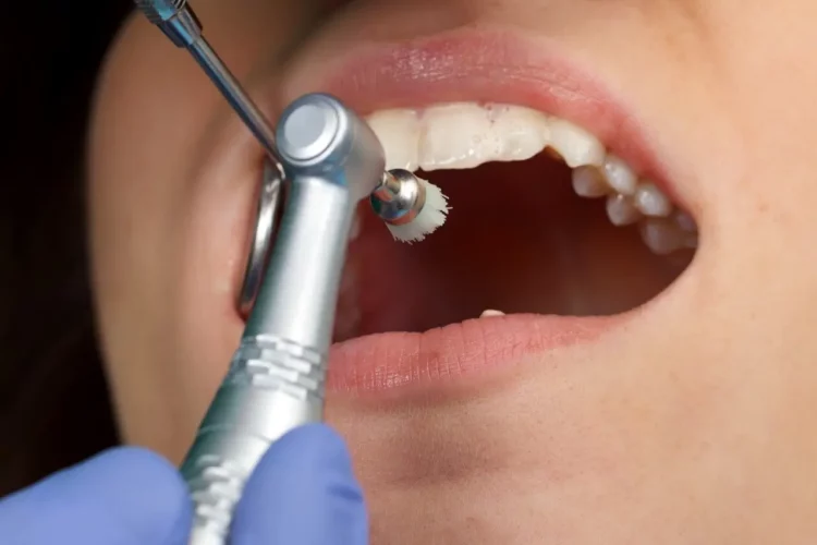 Professionelle Zahnreinigung